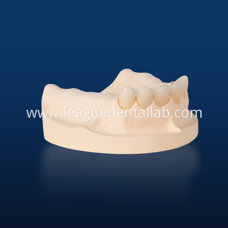 PFZ,Porcelain Fused to Zirconia,Zirconia Layered, Zirconia Veneered